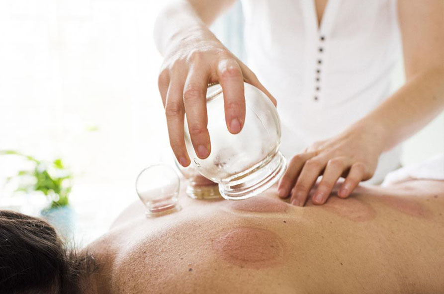 Dry Cupping Therapy